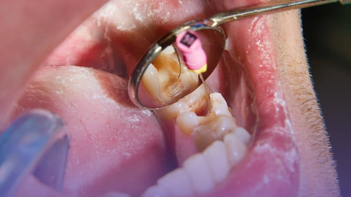 Sinus lifting and bone grafting are two important procedures for dental implants.