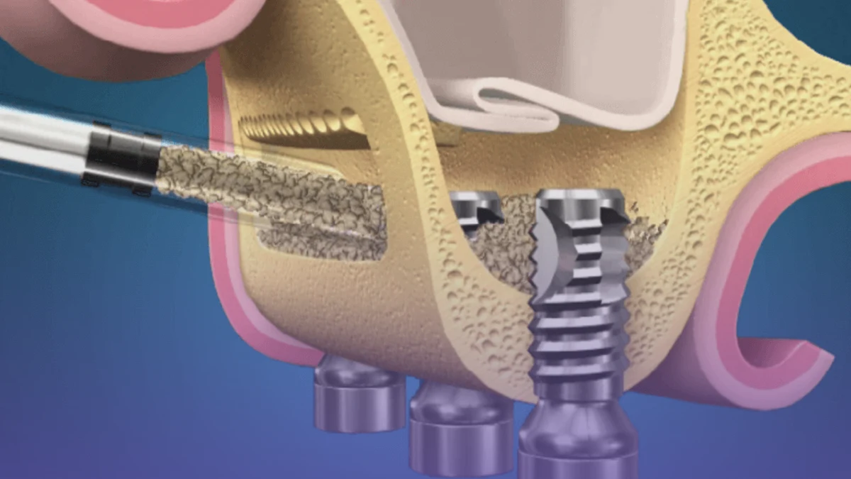 Many patients wonder about the differences between sinus lifting vs bone graft procedures.