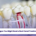 Discover the signs you might need a root canal treatment.