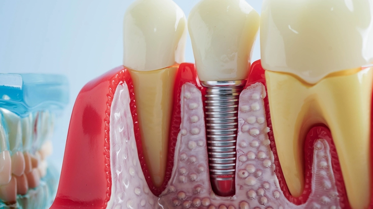 Explore teeth root canal treatment.