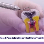 Know these 5 point before broken root canal tooth removal!