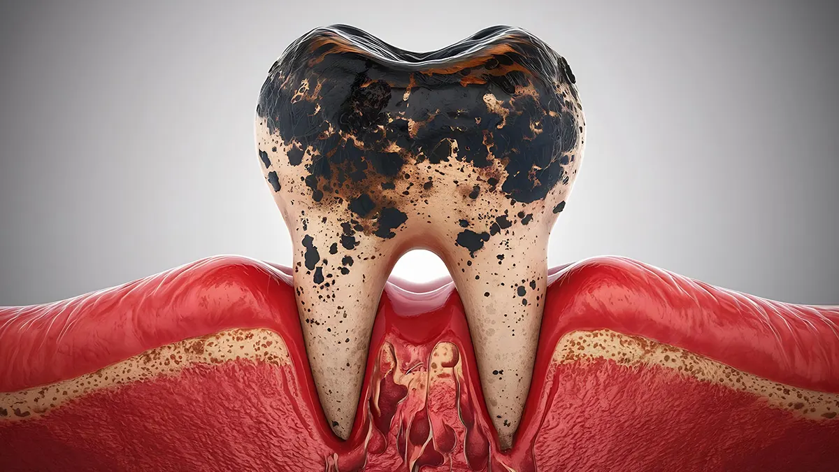 In this article, we will explore how to remove black stains from teeth.