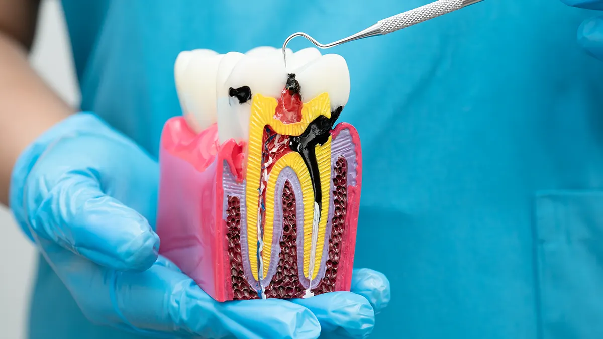 An image for root canal for cracked tooth.