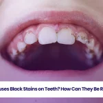 Learn what causes black stains on teeth.