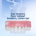 Smokers here can veneers turn yellow over time due to staining from smoking habits.
