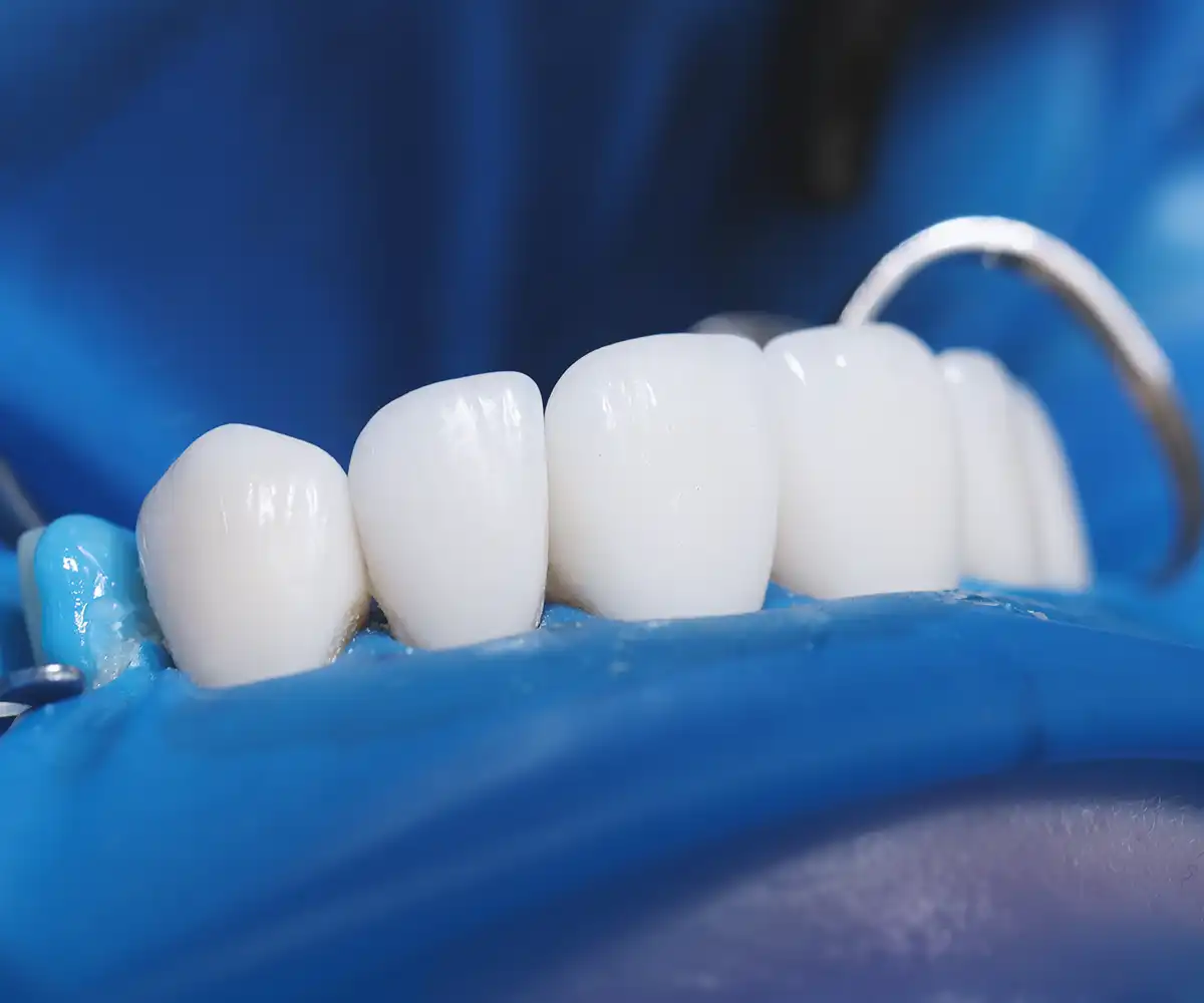 how to clean under veneers