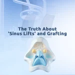 Sinus lift for dental implants at Aliadent supports stable and long lasting results.