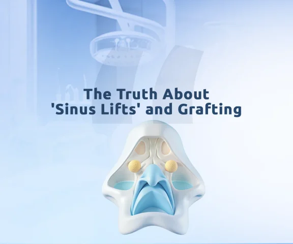 Sinus lift for dental implants at Aliadent supports stable and long lasting results.