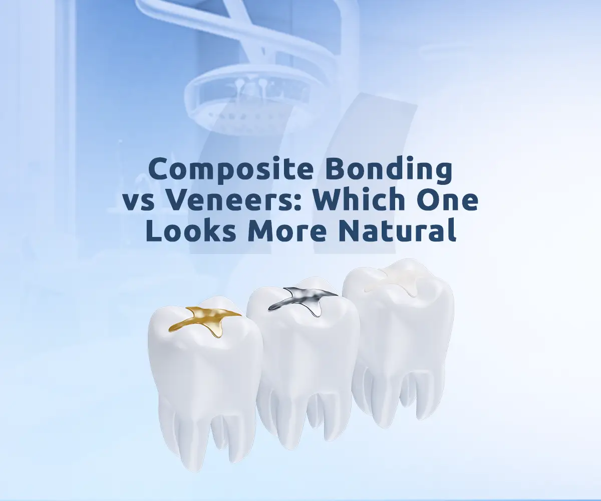 Composite bonding vs veneers comparison: which is better for your dental needs?