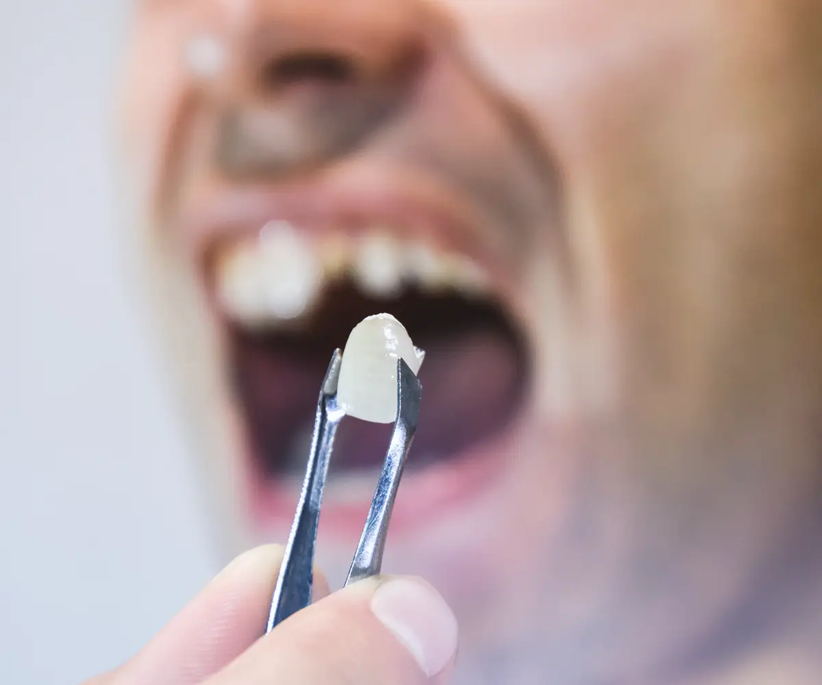 Why Do Dental Implants Fail: Early Warning Signs 6 peri implantitis symptoms