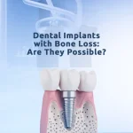 Dental Implants with Bone Loss: Are They Possible? 2 An image about dental implants with bone loss and treatment options for bone restoration.