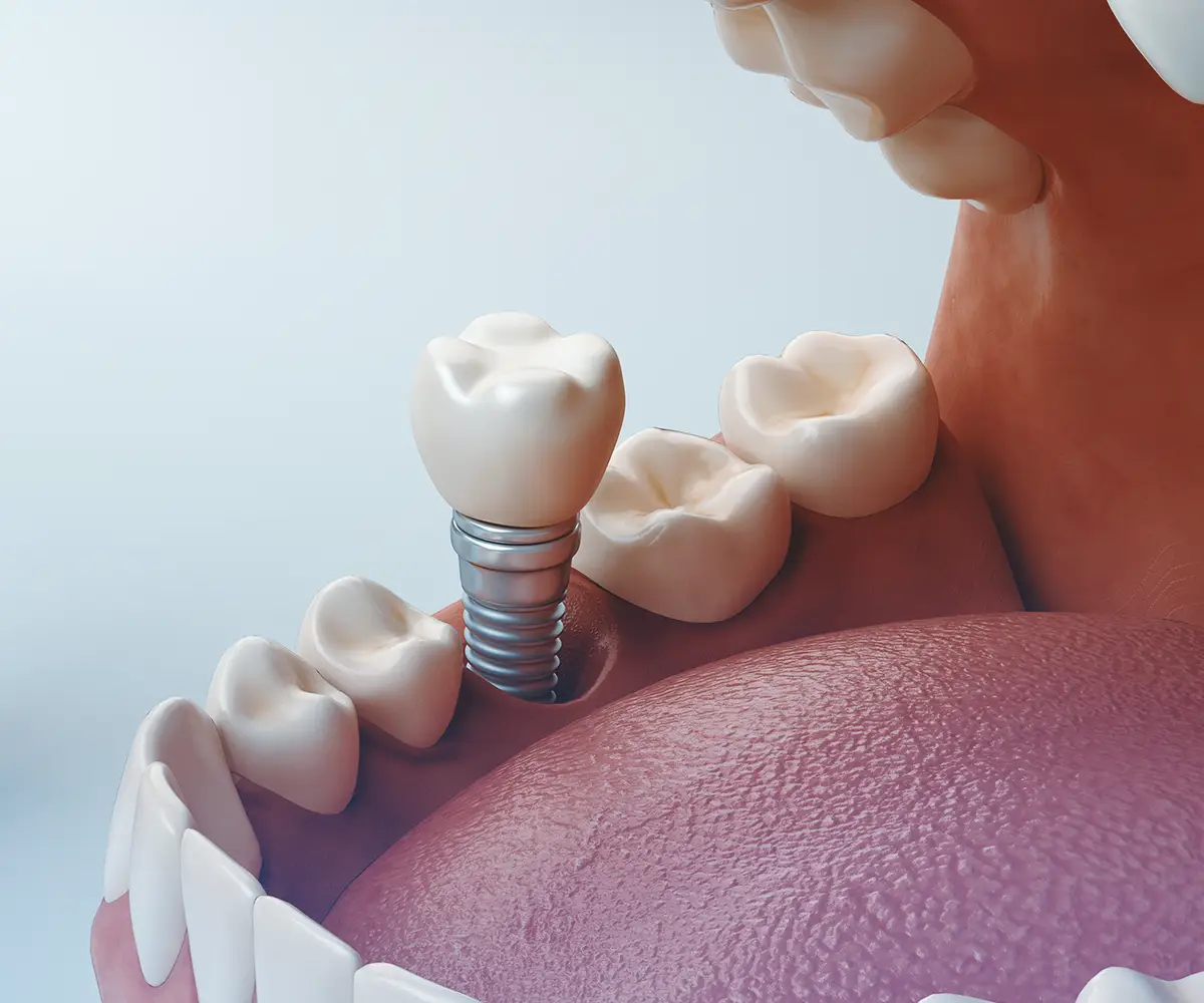 implant stability