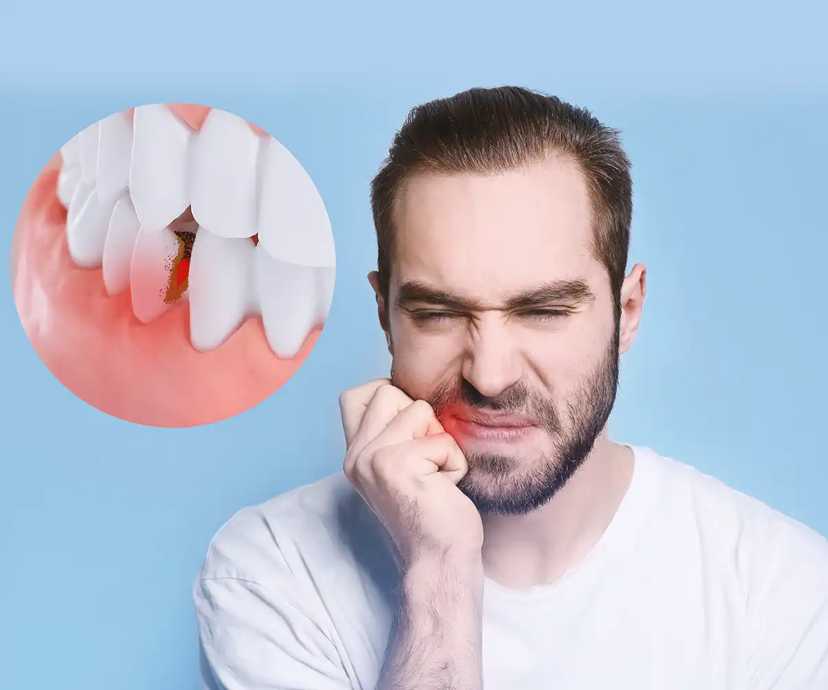Dry Socket After Wisdom Tooth Removal: The Early Signs 5 wisdom tooth extraction blood clot and dry socket prevention
