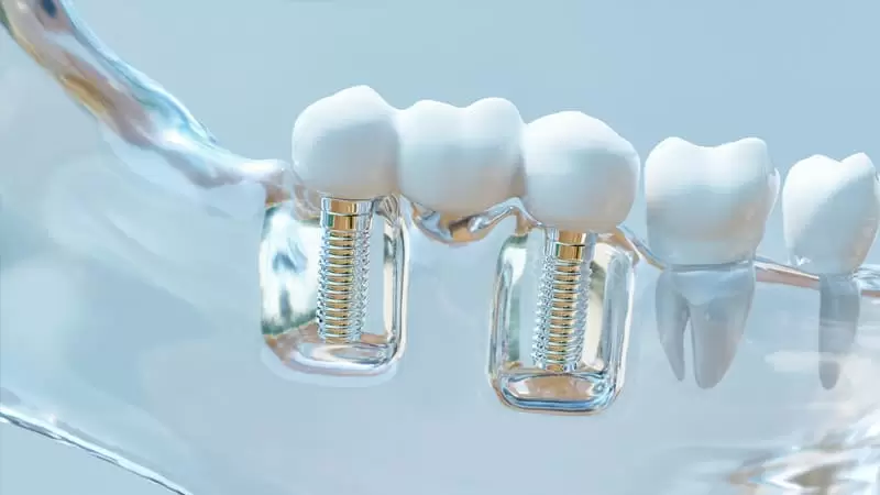 Implants dentaires All On Four 4 L'implant dentaire All-on-Four est une méthode de traitement que nous utilisons pour remplacer les dents manquantes de manière permanente et esthétique.