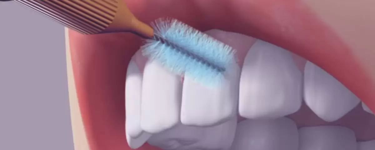 Cepillo interdental 4 Un cepillo interdental es una herramienta diseñada para limpiar los espacios estrechos entre los dientes. Es tan efectivo como usar hilo dental.
