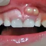 Un absceso dental se produce como resultado de una infección dentro del diente y puede causar síntomas como dolor, hinchazón y sensibilidad.