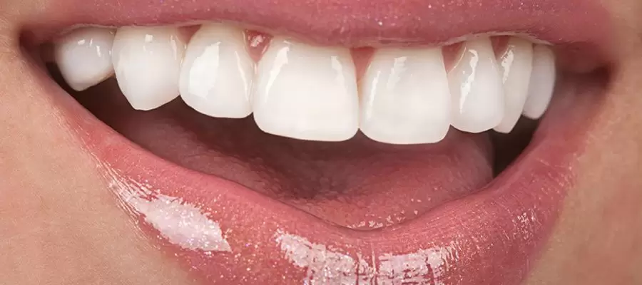 Processus de blanchiment des dents (blanchiment) ; C'est une solution efficace pour obtenir un sourire éclatant, aidant les dents décolorées à retrouver leur blancheur naturelle.