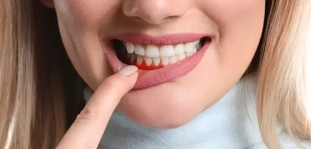 Diş Eti Kanaması Sebepleri Nelerdir? 4 Diş eti kanaması sebepleri arasında genellikle kötü ağız hijyeni veya diş eti hastalıkları gibi faktörler yer almaktadır.