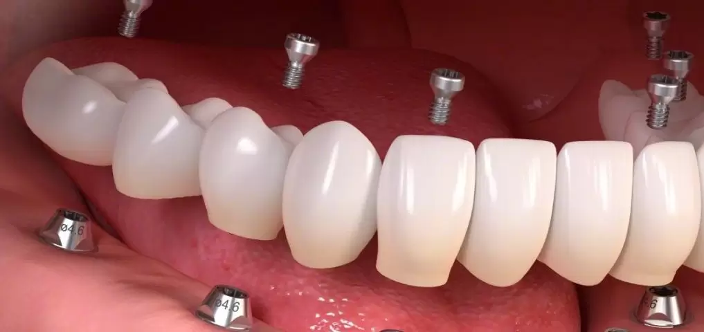 Su búsqueda del mejor tratamiento con implantes en Estambul llega a su fin con Aliadent. ¡Descubre las soluciones dentales estéticas y de calidad que te ofrecemos!