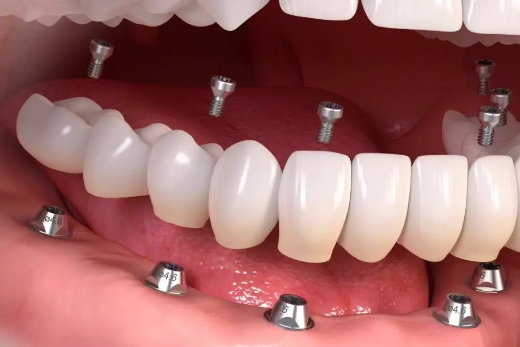 Su búsqueda del mejor tratamiento con implantes en Estambul llega a su fin con Aliadent. ¡Descubre las soluciones dentales estéticas y de calidad que te ofrecemos!