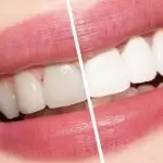 Como Aliadent, nuestro servicio de blanqueamiento dental en Estambul Levent se encuentra entre los tratamientos dentales estéticos ofrecidos por dentistas expertos.