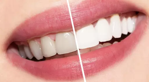 Como Aliadent, nuestro servicio de blanqueamiento dental en Estambul Levent se encuentra entre los tratamientos dentales estéticos ofrecidos por dentistas expertos.