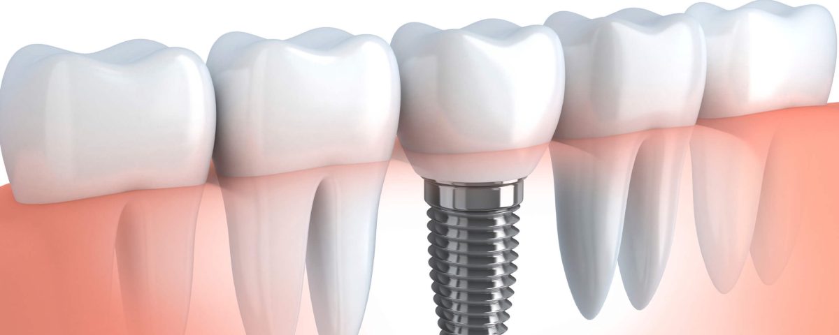 Levent İmplant 4 Levent'teki İstanbul'da implant tedavisi, uzman diş hekimlerimiz tarafından sunulan estetik ve kaliteli diş restorasyonları sağlamaktadır.