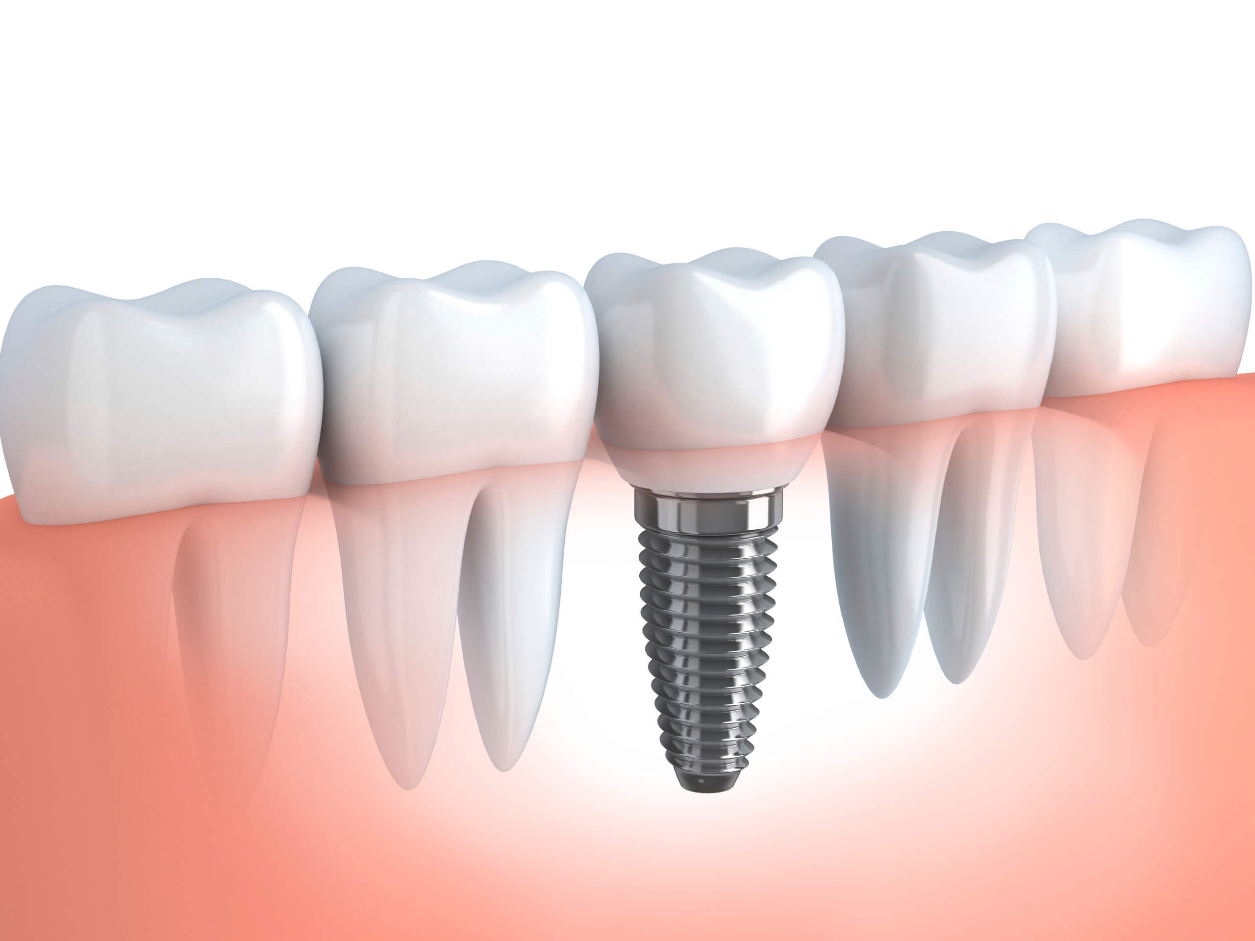 Levent'teki İstanbul'da implant tedavisi, uzman diş hekimlerimiz tarafından sunulan estetik ve kaliteli diş restorasyonları sağlamaktadır.