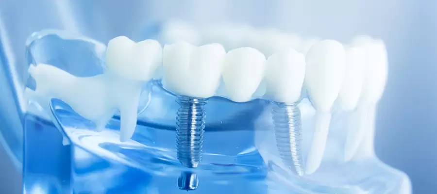 La radiografía panorámica es una técnica de imagen radiológica que utilizamos en Aliadent y que proporciona una imagen general de los dientes y de los tejidos circundantes.