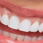 Les obturations en porcelaine et les restaurations inlay-onlay sont une méthode de traitement moderne utilisée pour réparer les dommages aux dents de manière esthétique et durable.