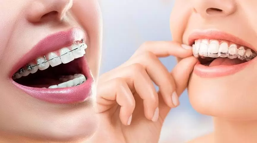 Si vous vous demandez comment utiliser les aligneurs transparents, une méthode largement utilisée dans le traitement de redressement des dents, vous pouvez satisfaire votre curiosité avec Aliadent.