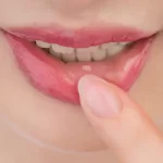 Aft nedir sorusu aklımızı kurcalayabilmektedir. Bu ağız içinde sıkça görülen ve genellikle ağrılı yaralara neden olan bir süreçtir.