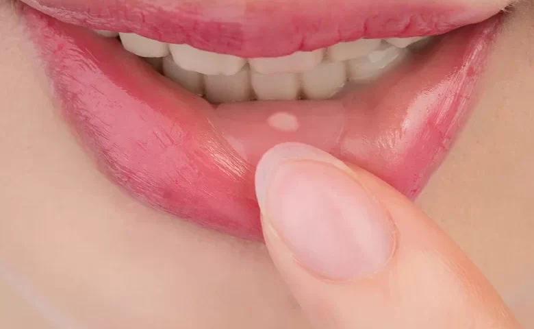 Aft nedir sorusu aklımızı kurcalayabilmektedir. Bu ağız içinde sıkça görülen ve genellikle ağrılı yaralara neden olan bir süreçtir.