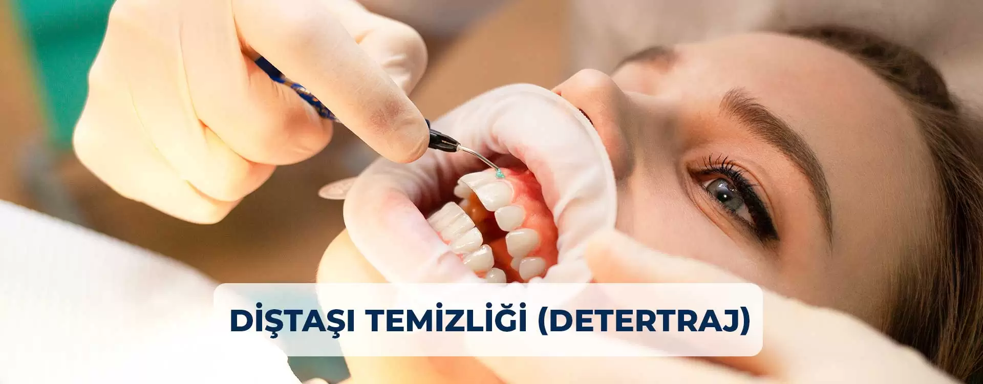 ¿Tienes dientes amarillentos, placa y mal aliento? Hazte una limpieza dental con limpieza de sarro en Estambul y disfruta de una sonrisa saludable.