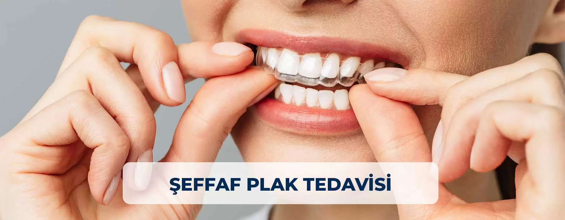 Tratamiento con placa transparente en Estambul: consiga una sonrisa estética con soluciones de corrección dental discretas y cómodas. Los alineadores transparentes ayudan a enderezar los dientes.