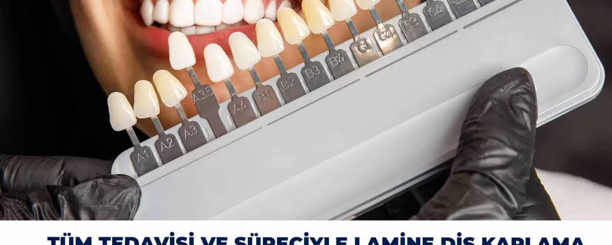 Découvrez l'ensemble du processus de traitement des facettes dentaires stratifiées. Des sourires parfaits accompagnés d'un accompagnement expert pour des résultats esthétiques et durables.