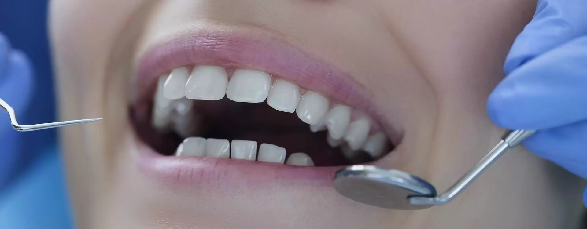 Limpieza de sarro dental en Estambul: un servicio que le ayudará a sentirse mejor con sus dientes y hará que su sonrisa sea más fresca.