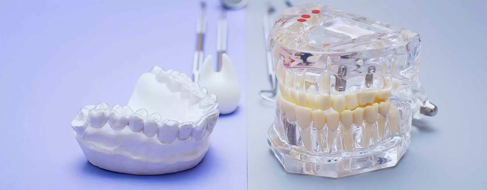 Soins dentaires de qualité chez Aliadent avec prothèses implanto-portées, solutions esthétiques et fonctionnelles.