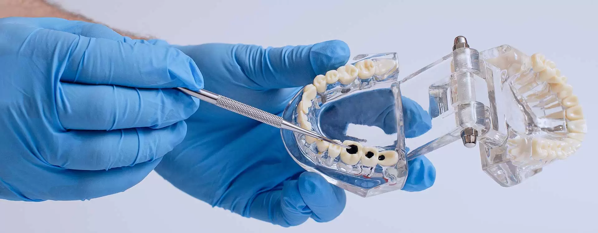 Si vous vous demandez ce que sont les prothèses dentaires sur implants, consultez notre article.