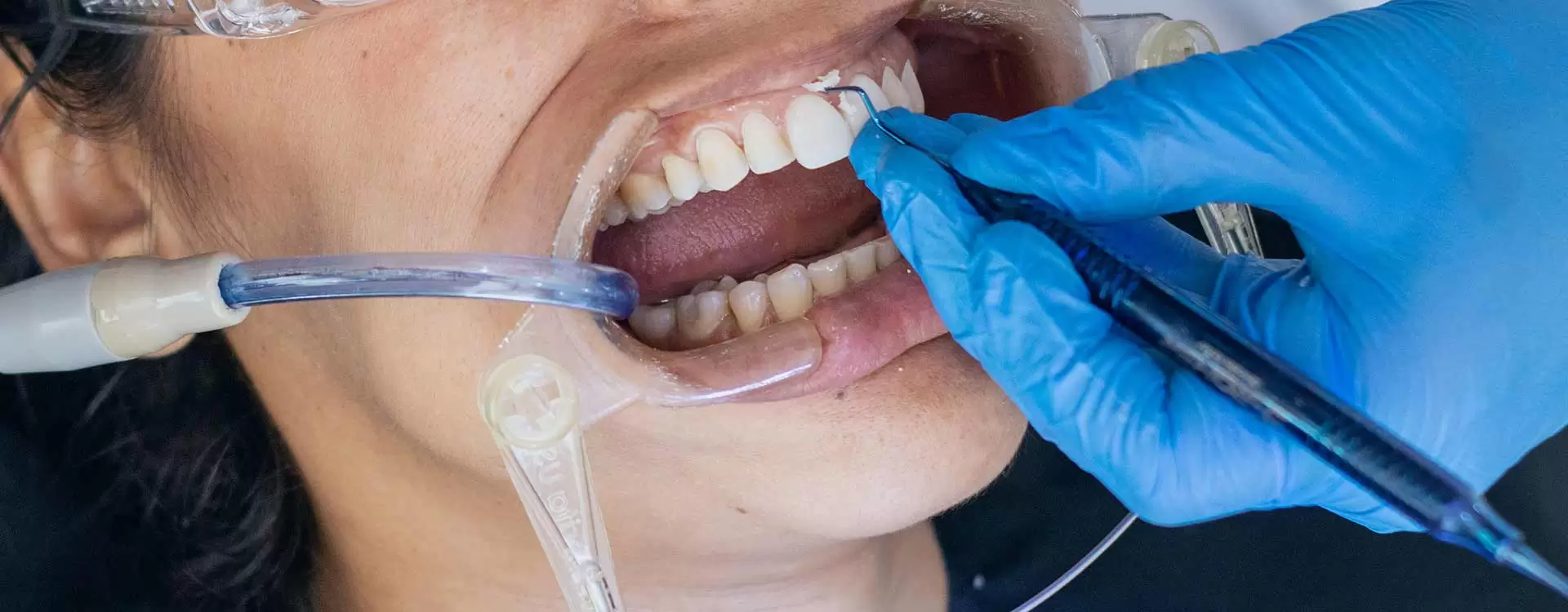 Descubra la diferencia en la limpieza del sarro dental en Estambul con Aliadent. Deshazte del sarro y consigue unas sonrisas bonitas.