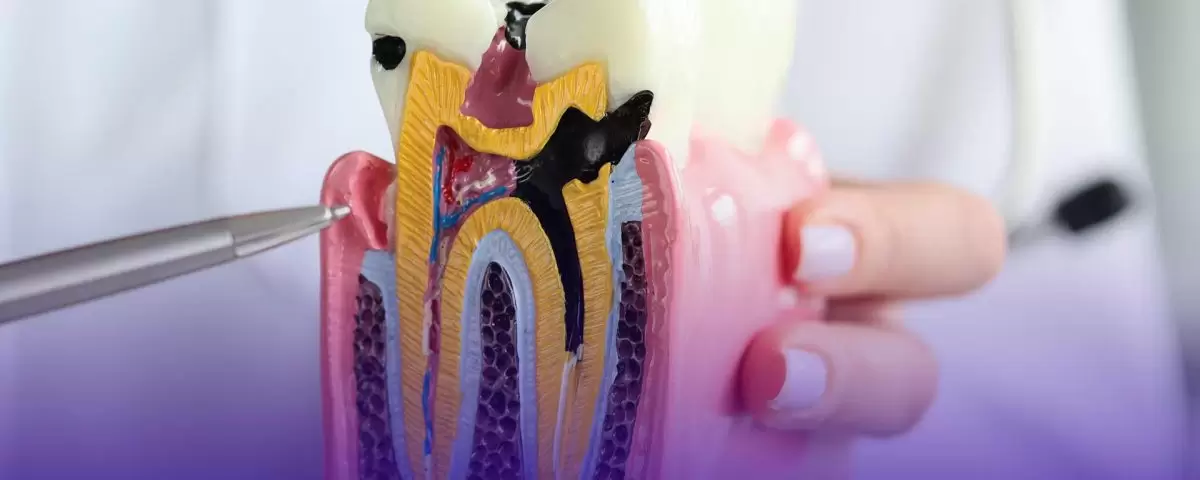 Le traitement de canal radiculaire est une procédure importante qui vise à nettoyer les infections à l’intérieur de la dent et à protéger la dent.