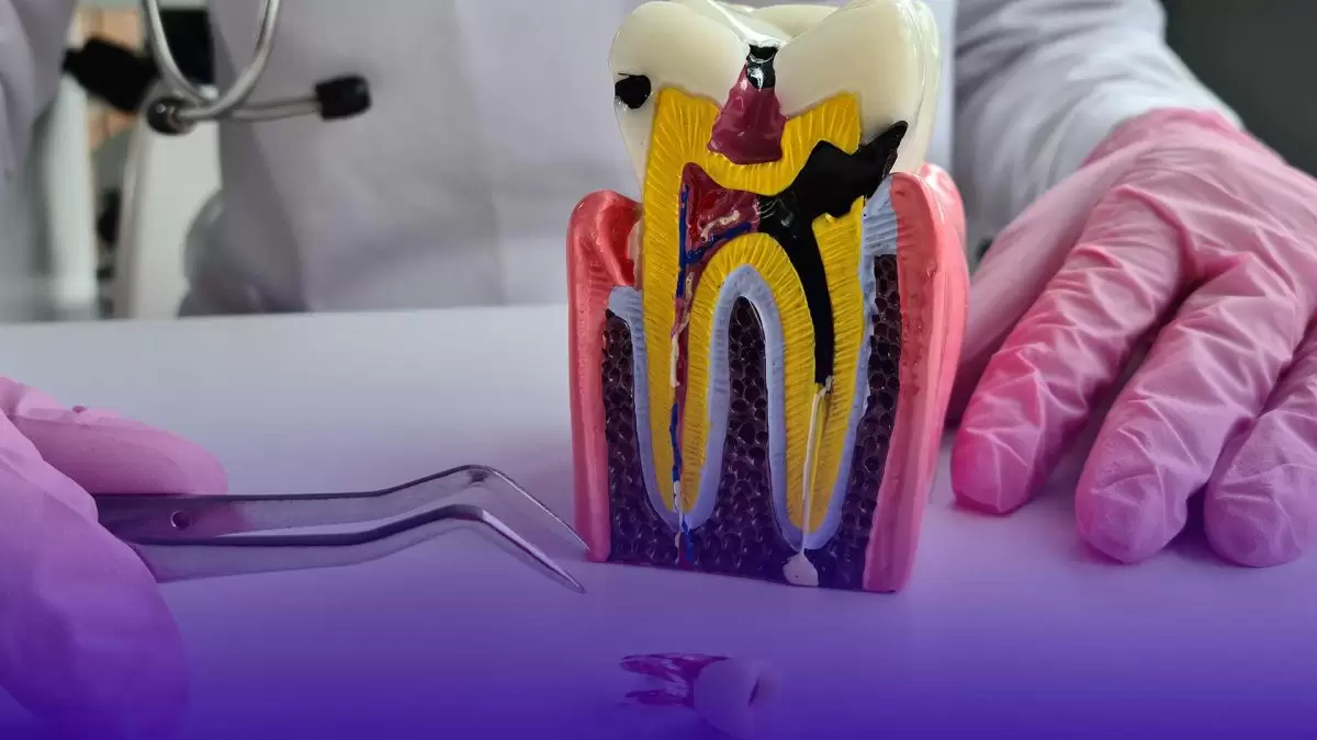 Les procédures effectuées lors du traitement du canal radiculaire comprennent l’élimination des tissus dentaires infectés et le nettoyage du canal radiculaire.