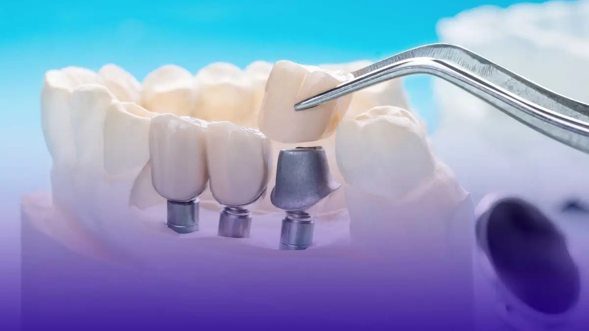 ¿Es el tratamiento con implantes dentales adecuado para usted?