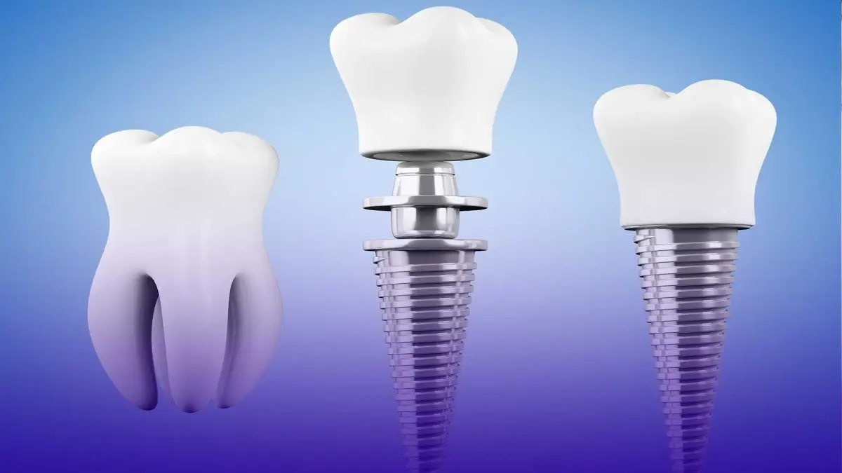 ¿Qué es la aplicación de implantes dentales y cómo se realiza?