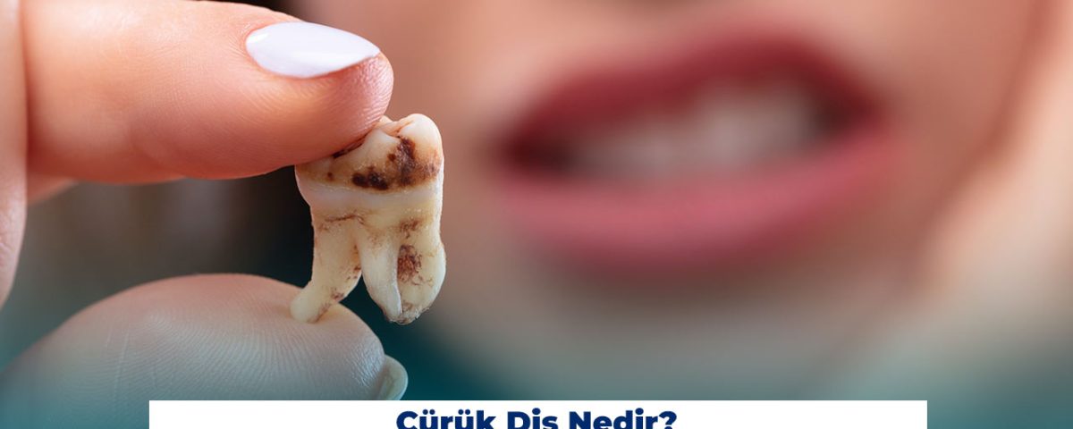 Çürük Diş Nedir? Çürük Diş Ağrısına Ne İyi Gelir?