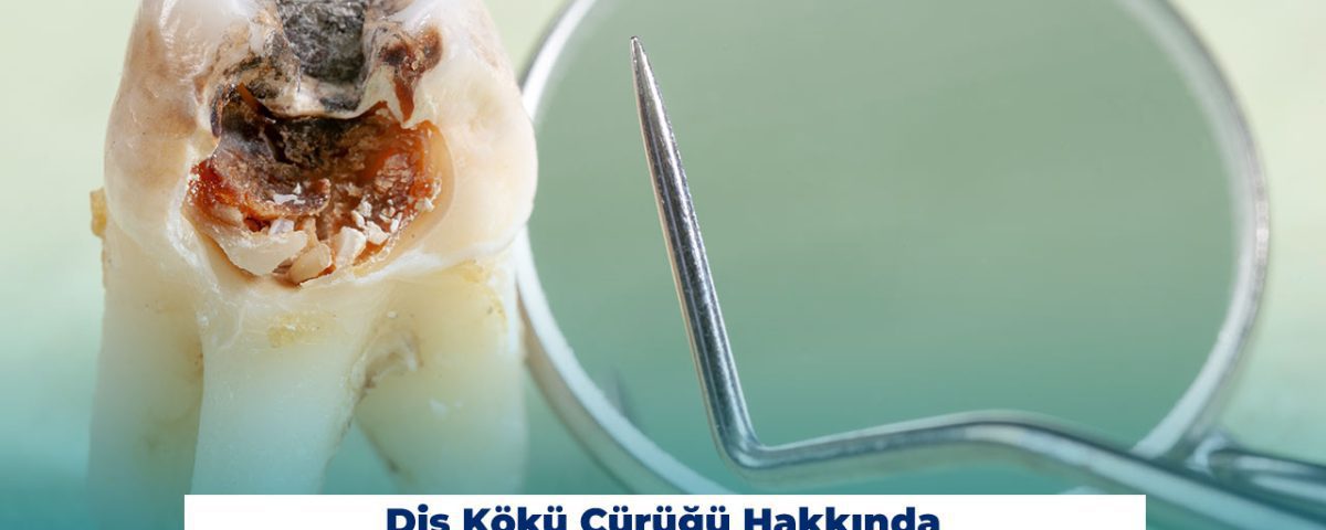Diş Kökü Çürüğü Hakkında Bilmeniz Gerekenler