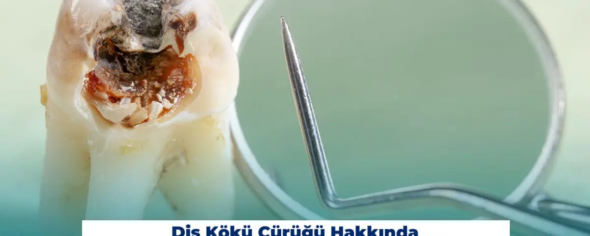 Какво трябва да знаете за кариеса на корена на зъбите