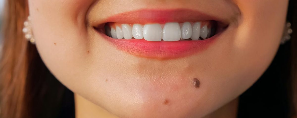 Dişlerinde siyah lekeler olanlar buraya, önemli bilgilere ulaşın.