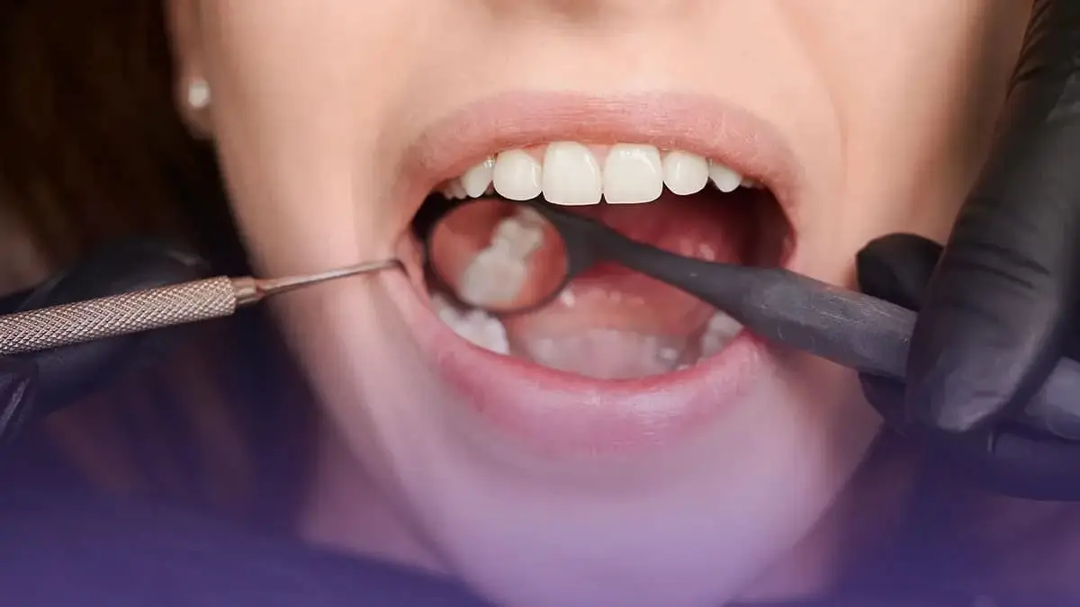 La gingivectomie est l’ablation chirurgicale des gencives endommagées en cas de maladie des gencives.