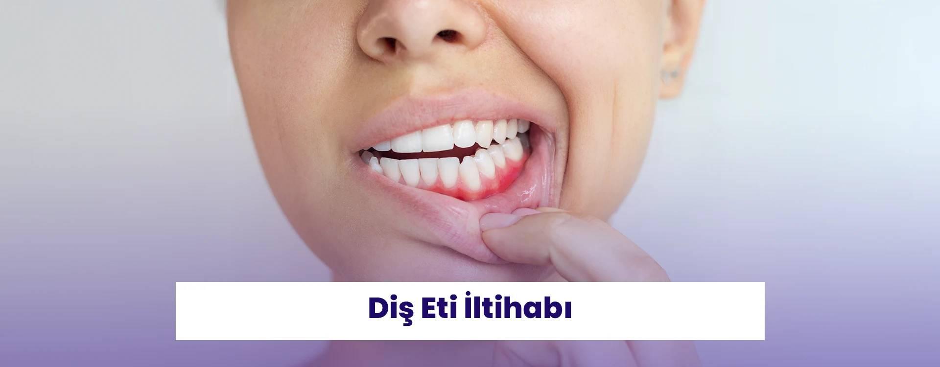 İnsan sağlığı açısından dikkat edilmesi gerekilen diş eti iltihabı konusunu keşfedin.
